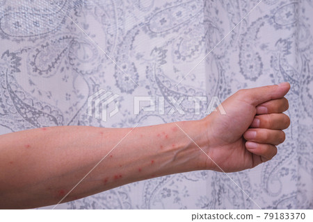 Caterpillar dermatitis [4th day of onset] 79183370