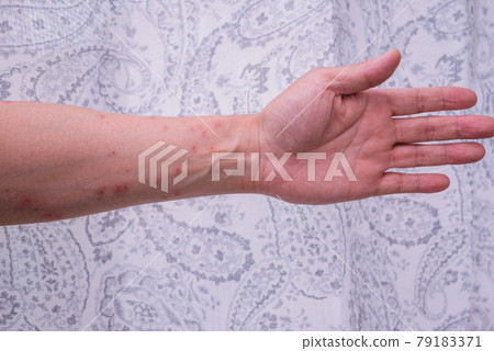 毛蟲皮炎 [發病第 4 天] 79183371