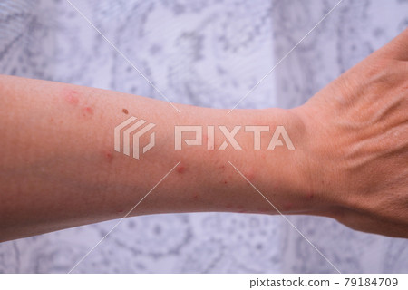 Caterpillar dermatitis [4th day of onset] 79184709