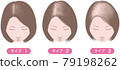 Female androgenetic alopecia, Ludwig classification, classification by type 79198262