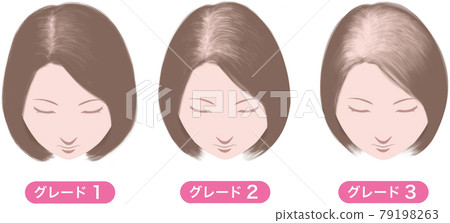 女性雄激素性脫髮,路德維希分類,等級符號 女性雄激素性脫髮,路德維希分類,等級符號 79198263