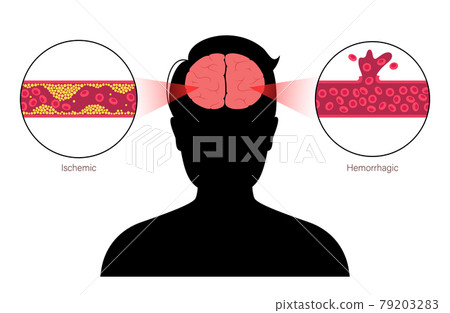 Brain stroke ishemic and hemorrhagic 79203283