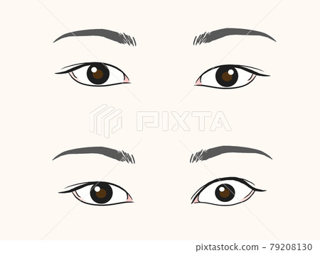 甲狀腺眼病（格雷夫斯眼病）與正常眼的對比圖 79208130