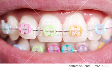 White teeth with wired orthodontic brackets. White teeth with wired orthodontic brackets. 79213909