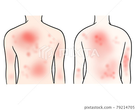 Illustration of two men and women with dermatitis on their backs Illustration of two men and women with dermatitis on their backs 79214705