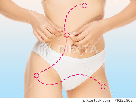 Marks on the women's hits, belly and legs before plastic surgery. Marks on the women's hits, belly and legs before plastic surgery. 79221802