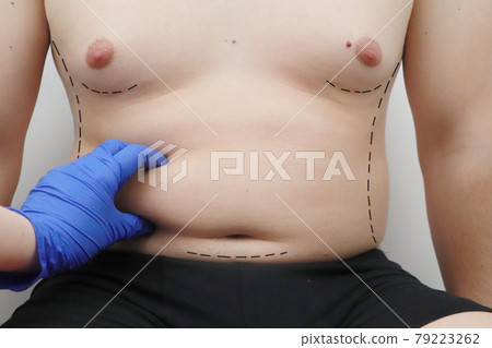 Tummy tuck, liposuction, breast surgery. A plastic surgeon prepares a man for plastic surgery. 79223262