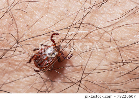 Blood-sucking mite on a human skin macro Blood-sucking mite on a human skin macro 79226607