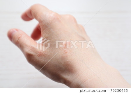 Dermatitis Skin trouble Rough skin Eczema Hand eczema Housewife eczema Housework eczema 14 79230455