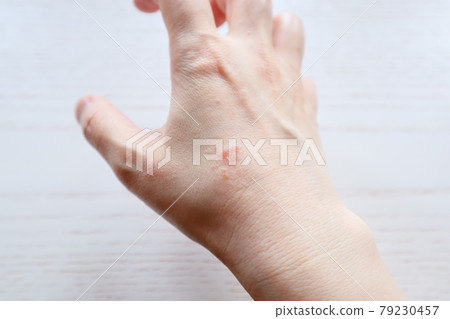 皮炎 皮膚問題 皮膚粗糙 濕疹 手部濕疹 家庭主婦濕疹 家務濕疹 12 皮炎 皮膚問題 皮膚粗糙 濕疹 手部濕疹 家庭主婦濕疹 家務濕疹 12 79230457