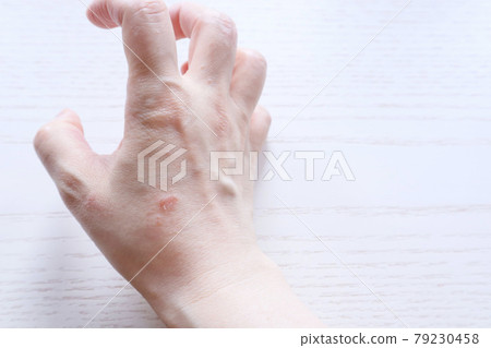 Dermatitis Skin trouble Rough skin Eczema Hand eczema Housewife eczema Housework eczema 11 79230458
