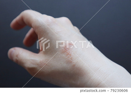 Dermatitis Skin trouble Rough skin Eczema Hand eczema Housewife eczema Housework eczema 20 79230606