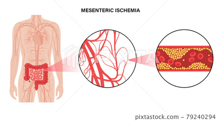 Mesentric ishemia disease 79240294
