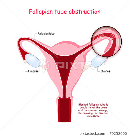 Fallopian tube obstruction. Cross section of Uterus. Close-up of Blocked fallopian tube 79252000
