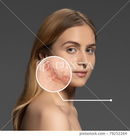 Problems with acnes on female face skin. Portrait of young girl 79252264