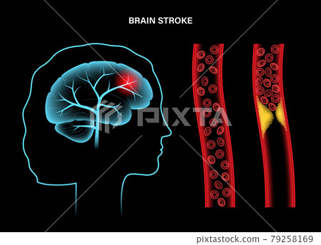 Brain stroke ishemic 79258169