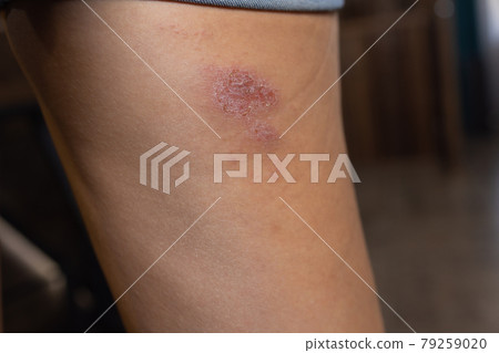 Abrasion on the woman's knee. Injured leg with a red wound. Medical treatment for first aid. 79259020