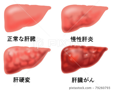 肝病 4 插圖 79260793