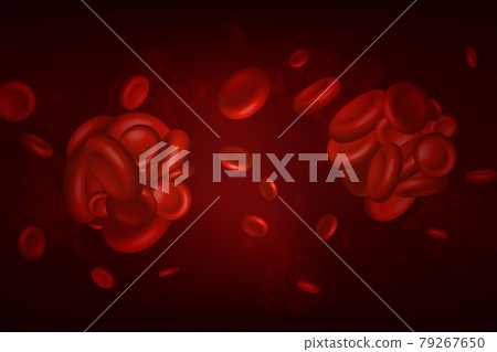 Blood clots, thrombus or embolus with coagulated erythrocytes. 79267650