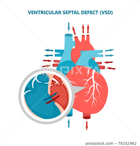 Ventricular septal defect VSD with heart blood flow. Human heart muscle diseases cross-section. 79282962