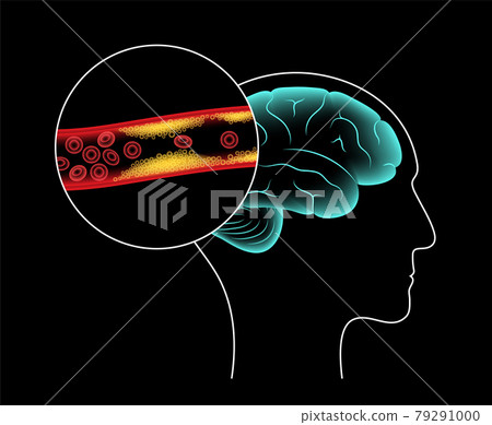 Brain stroke ishemic 79291000