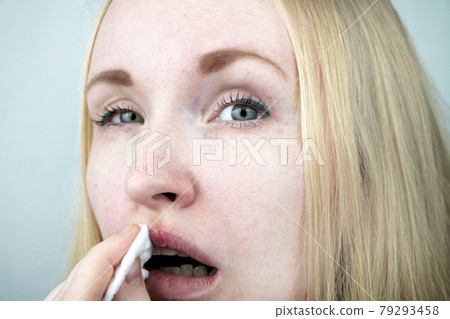 Beautiful young woman, lips infected with herpes virus. The concept of treatment of the herpes virus Beautiful young woman, lips infected with herpes virus. The concept of treatment of the herpes virus 79293458