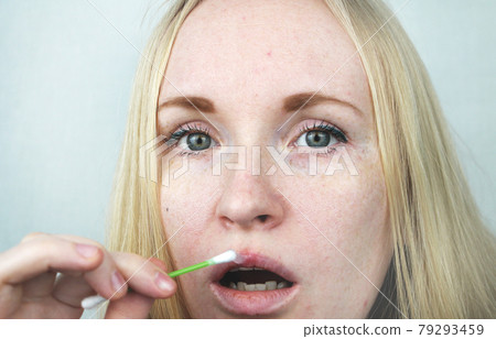 Beautiful young woman, lips infected with herpes virus. The concept of treatment of the herpes virus Beautiful young woman, lips infected with herpes virus. The concept of treatment of the herpes virus 79293459