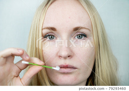 Beautiful young woman, lips infected with herpes virus. The concept of treatment of the herpes virus Beautiful young woman, lips infected with herpes virus. The concept of treatment of the herpes virus 79293460