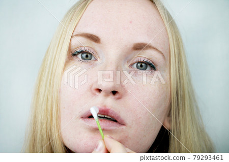 Beautiful young woman, lips infected with herpes virus. The concept of treatment of the herpes virus Beautiful young woman, lips infected with herpes virus. The concept of treatment of the herpes virus 79293461