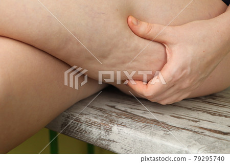 Woman shows holding and pushing the skin of the legs cellulite, orange peel. 79295740