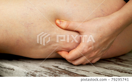 Woman shows holding and pushing the skin of the legs cellulite, orange peel. Woman shows holding and pushing the skin of the legs cellulite, orange peel. 79295741