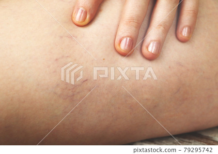 Varicose veins and capillary veins in the legs. Medical inspection and treatment Varicose veins and capillary veins in the legs. Medical inspection and treatment 79295742