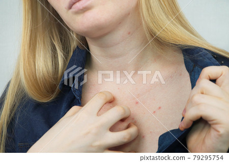 Allergy concept. Young woman with pimples on the chest, closeup 79295754