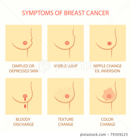breast cancer, self examination, tumor breast cancer, self examination, tumor 79309225