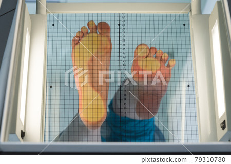 The patient's feet are placed on a special apparatus for determining the load. On one foot, the load is uniform, the second foot is on the toe. It is clearly seen how the load is distributed when 79310780