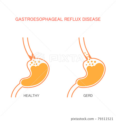 reflux  disease 79311521