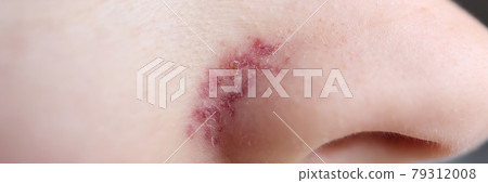 Closeup of red inflamed rash on womans nose 79312008