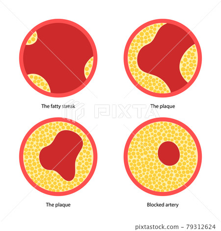 Cholesterol and atherosclerosis 79312624