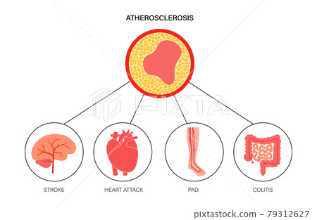Types of ishemia 79312627