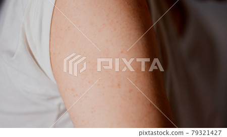 Image of atopic dermatitis in a man scratching his upper arm 79321427