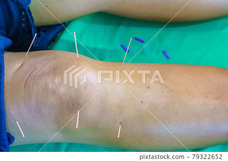 Close-up of khee and leg with steel needle during procedure of acupuncture therapy. Alternative medicine 79322652