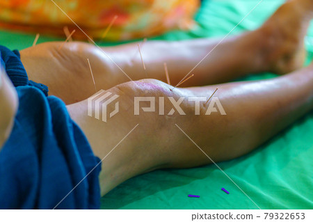Close-up of khee and leg with steel needle during procedure of acupuncture therapy. Alternative medicine 79322653