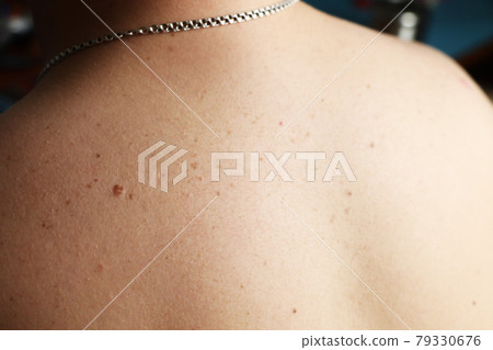 Close up detail of the bare skin on a man back with scattered moles and freckles , Disorders of body , Checking benign moles , Sun effect on skin. 79330676