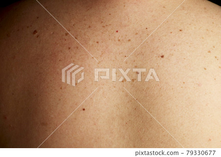 Close up detail of the bare skin on a man back with scattered moles and freckles , Disorders of body , Checking benign moles , Sun effect on skin. Close up detail of the bare skin on a man back with scattered moles and freckles , Disorders of body , Checking benign moles , Sun effect on skin. 79330677