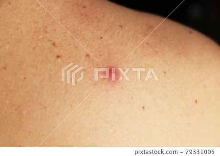 Photo of a pimple with pus on the back of a man Photo of a pimple with pus on the back of a man 79331005