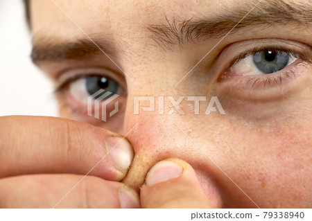 Closeup portrait young man looking at the camera, squeezing acne or blackheads on the nose. Close-up as background for the hygiene of the face and nose. Dermatology and skin problems. Oily skin face Closeup portrait young man looking at the camera, squeezing acne or blackheads on the nose. Close-up as background for the hygiene of the face and nose. Dermatology and skin problems. Oily skin face 79338940