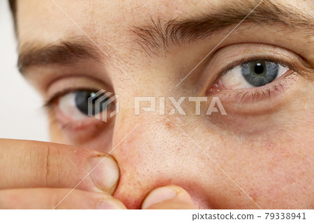 Closeup portrait young man looking at the camera, squeezing acne or blackheads on the nose. Close-up as background for the hygiene of the face and nose. Dermatology and skin problems. Oily skin face Closeup portrait young man looking at the camera, squeezing acne or blackheads on the nose. Close-up as background for the hygiene of the face and nose. Dermatology and skin problems. Oily skin face 79338941