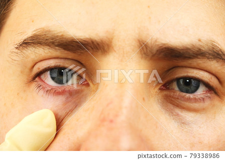 Conjunctivitis, tired eyes, red eyes, eye disease 79338986