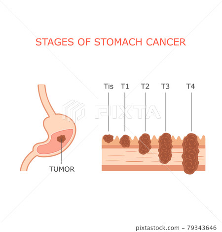 stomach cancer stages stomach cancer stages 79343646