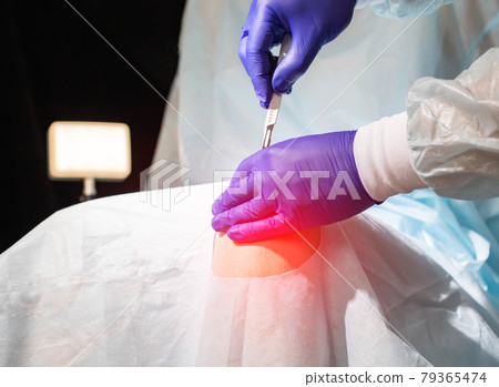 Doctor's hands with a scalpel near the patient's sore knee in the operating room. Knee replacement concept, arthroplasty 79365474